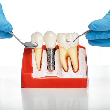 dental implant benefits